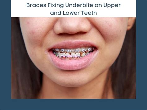 underbite repair braces